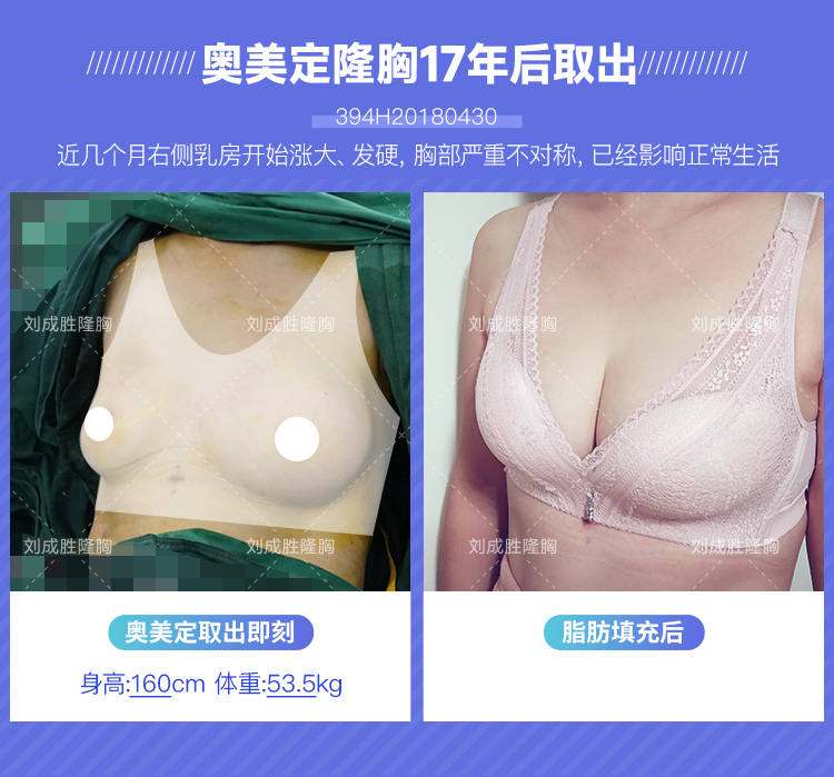 丰体针丰胸后的乳房外形异常及如何科学修复